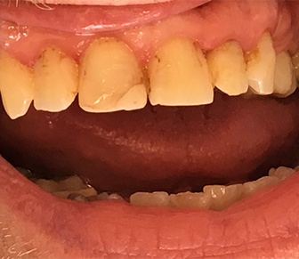 Discolored and damaged teeth before restorative dentistry