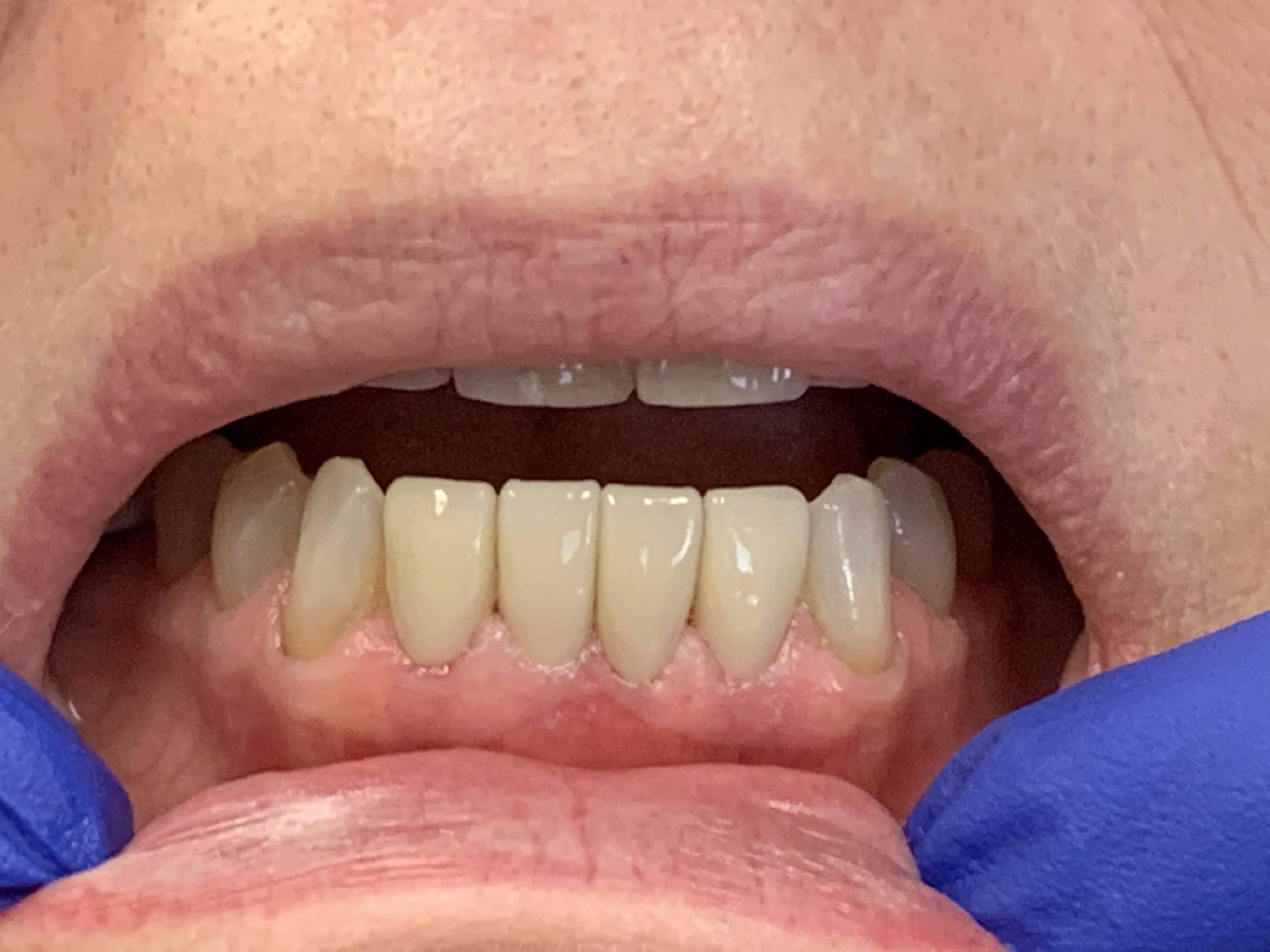 Perfected healthy smile after dental treatment