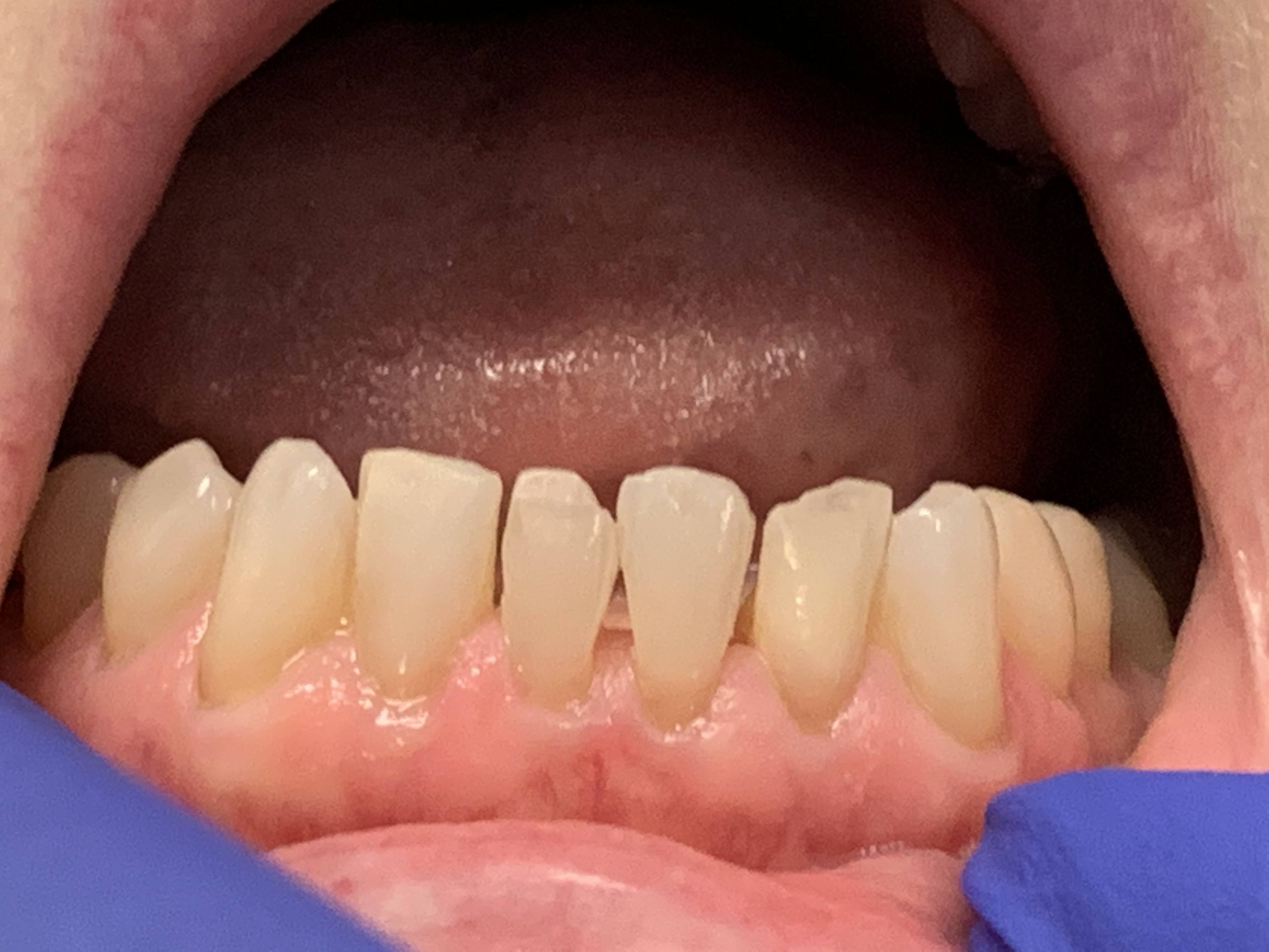 Discolored and damaged teeth before dental treatment