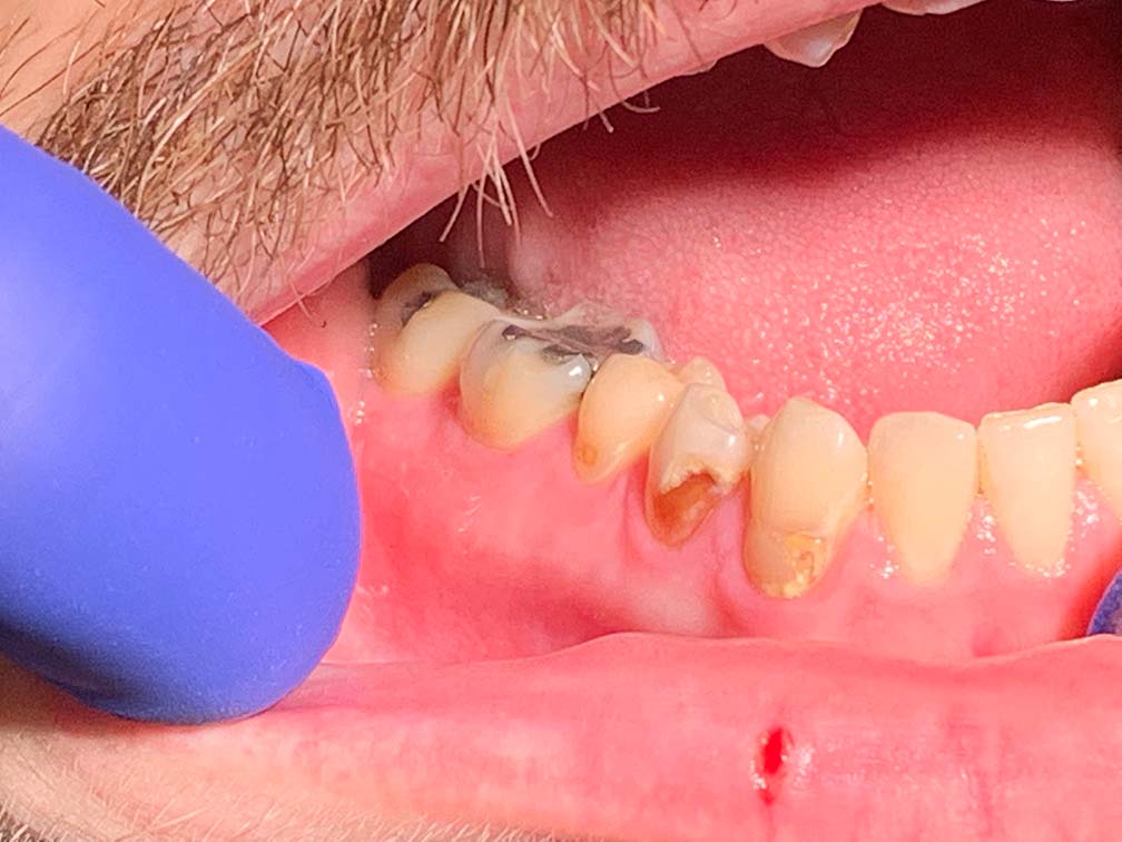 Discolored and damaged teeth before dental treatment
