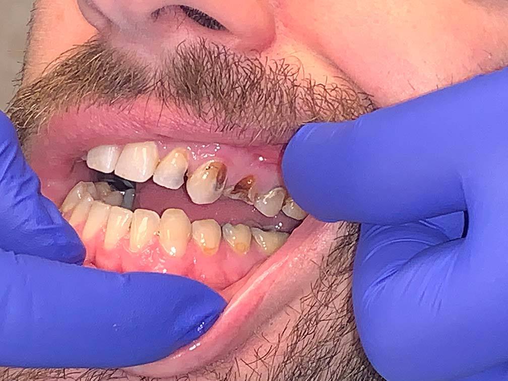 Discolored and damaged teeth before dental treatment