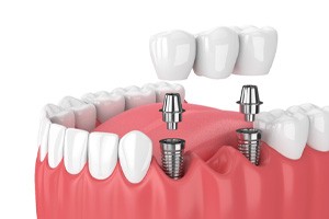 Illustration of implant bridge in Shorewood