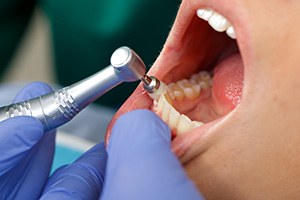 A hygienist performing a professional teeth cleaning