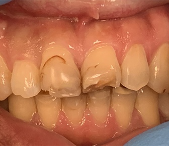Damaged smile before cosmetic dentistry