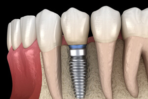 dental implant in the lower jaw