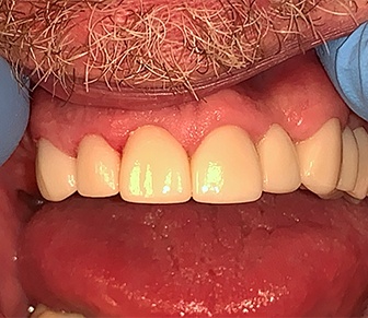 Healthy beautiful smile after restorative dentistry