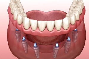 Illustration of implant denture for lower arch against pink background