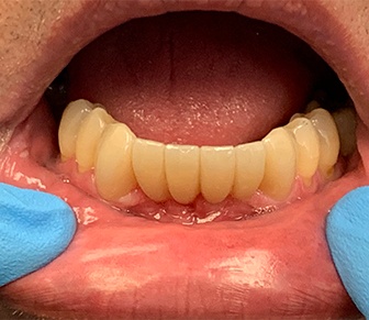 Healthy smile after fixed bridge restoration