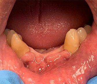 Row of missing bottom teeth before fixed bridge restoration