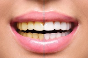 Before and after of teeth whitening in Shorewood