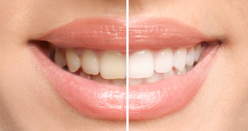 smile before and after teeth whitening